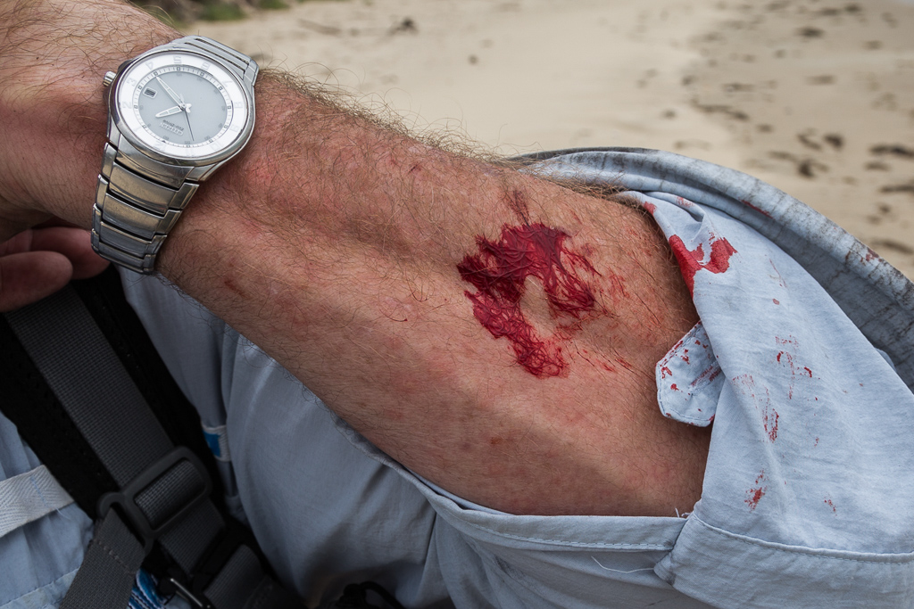 bleeding-arm-hiking